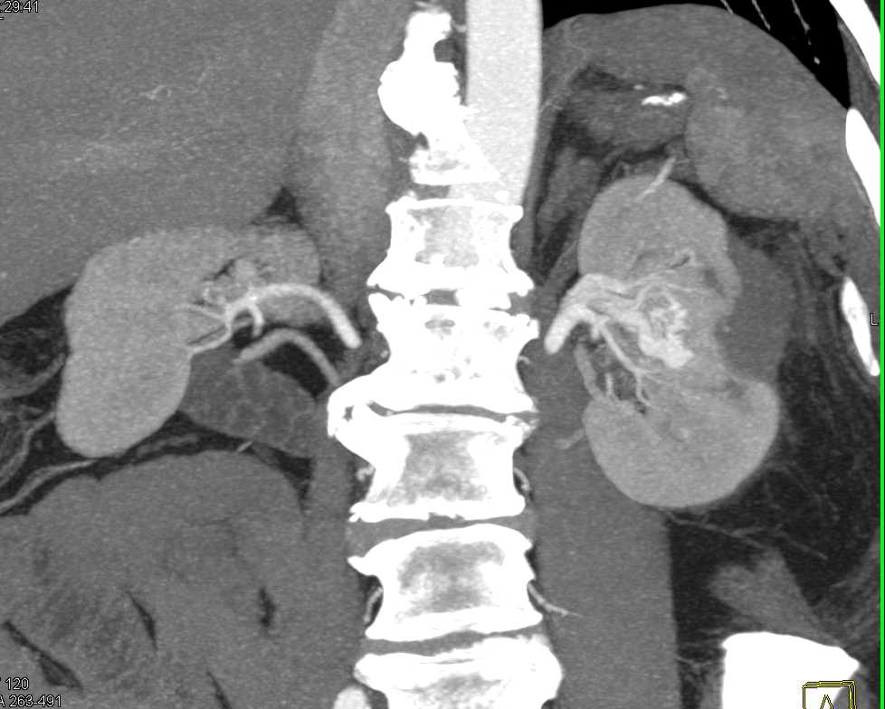 Arteriovenous (AV) Fistulae Left Kidney - CTisus CT Scan