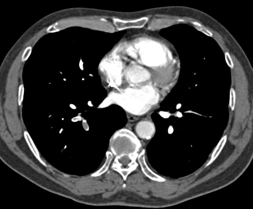 Encased Renal Artery by Tumor - CTisus CT Scan