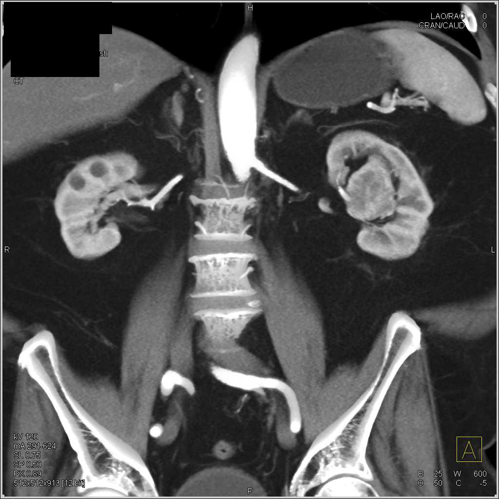 Transitional Cell Carcinoma Left Renal Pelvis - CTisus CT Scan