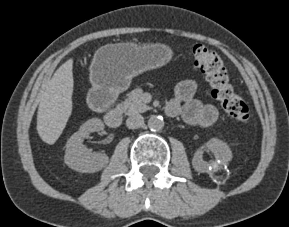 Post Ablation Changes Left Kidney - CTisus CT Scan