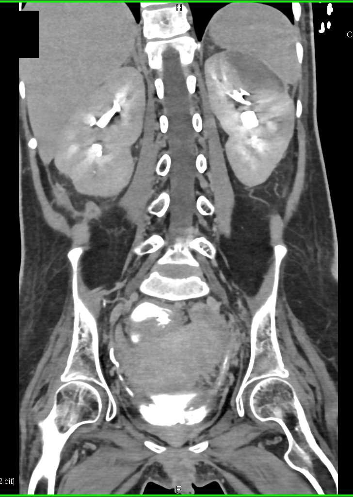 Renal Infarct Left Kidney - CTisus CT Scan