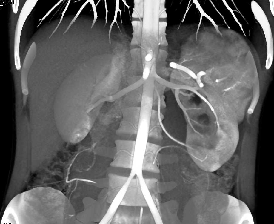 Left Ureteropelvic Junction (UPJ) Obstruction due to Crossing Artery ...