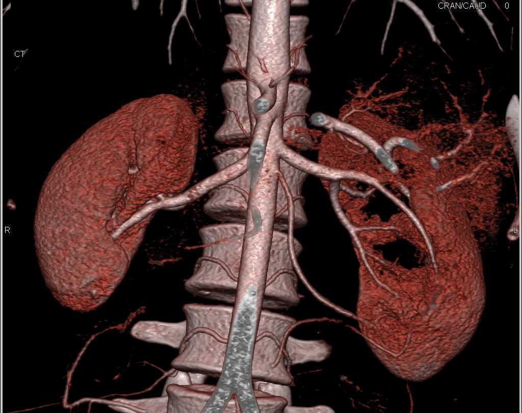 Left Ureteropelvic Junction (UPJ) Obstruction due to Crossing Artery Best Seen on 3D VRT - CTisus CT Scan