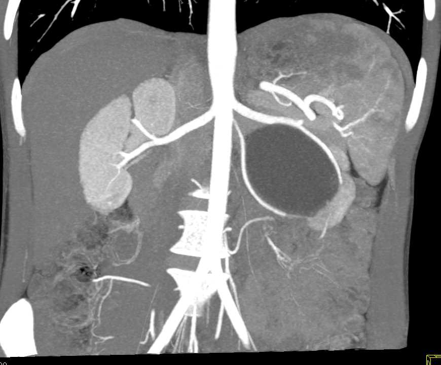 Left Ureteropelvic Junction (UPJ) Obstruction due to Crossing Artery Best Seen on 3D VRT - CTisus CT Scan