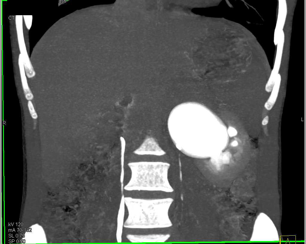 Left Ureteropelvic Junction (UPJ) Obstruction - CTisus CT Scan