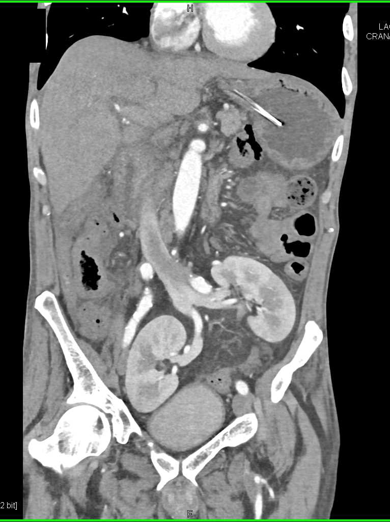 Pelvic Kidneys in 3D - CTisus CT Scan