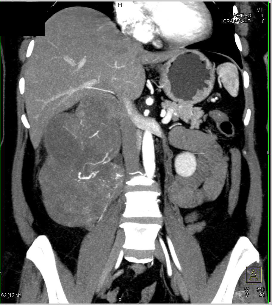 Sarcoma of the Right Kidney - CTisus CT Scan