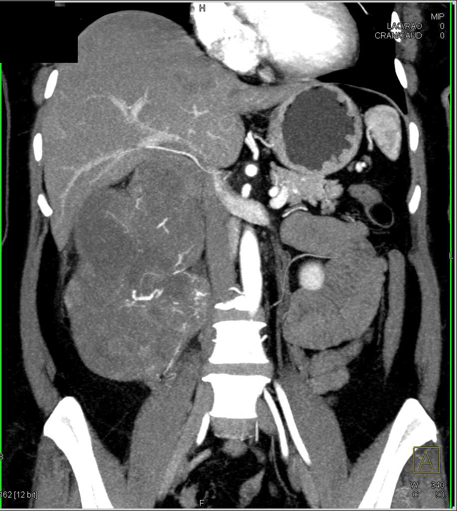 Sarcoma of the Right Kidney Zone - CTisus CT Scan