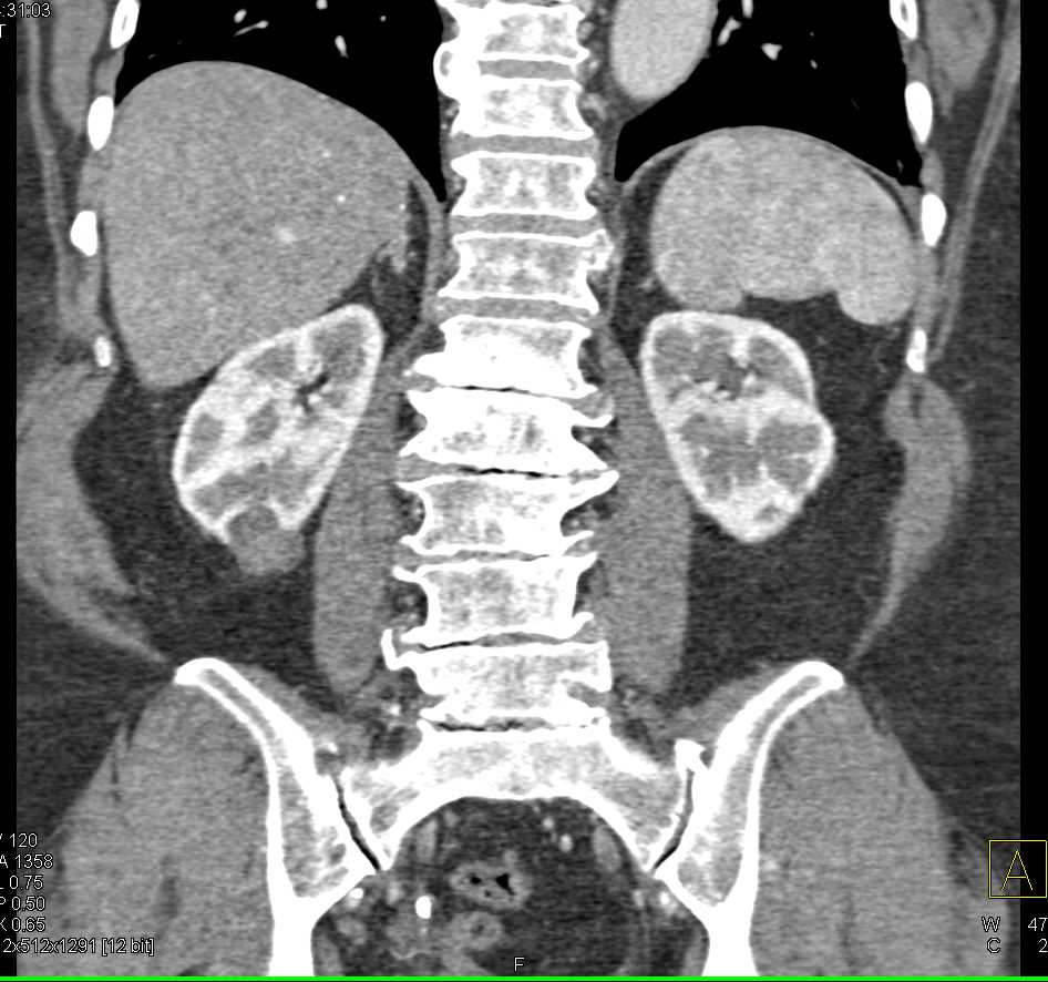 Incidental Renal Cell Carcinoma Lower Pole Right Kidney - CTisus CT Scan