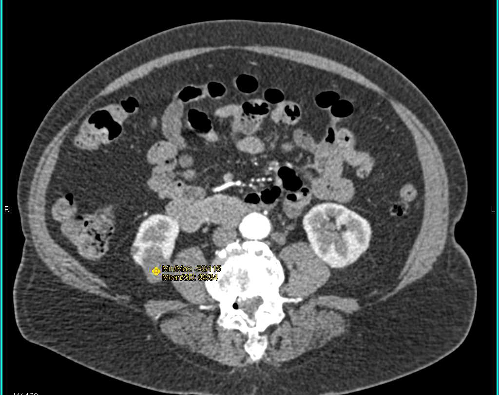 Incidental Renal Cell Carcinoma Lower Pole Right Kidney - CTisus CT Scan