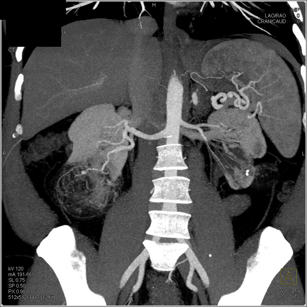 Bilateral Renal Angiomyolipomas - CTisus CT Scan