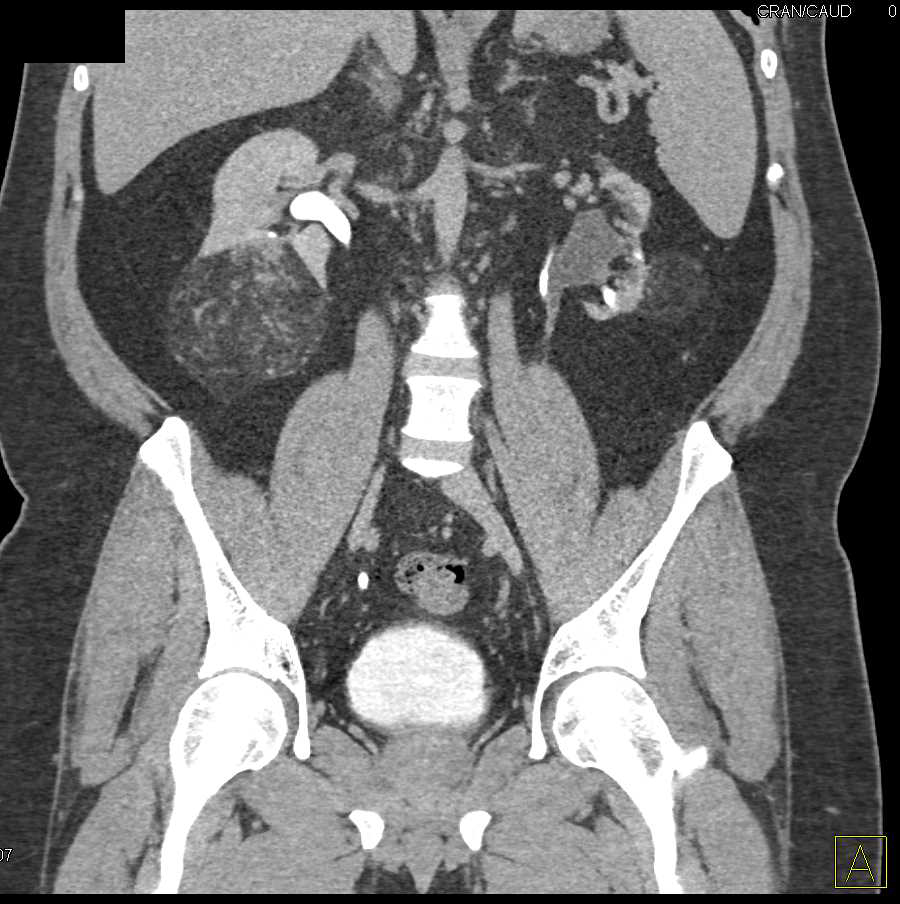 Bilateral Renal Angiomyolipomas - CTisus CT Scan