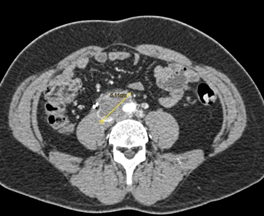 Recurrent Renal Cell Carcinoma to Local Nodes s/p Nephrectomy - CTisus CT Scan