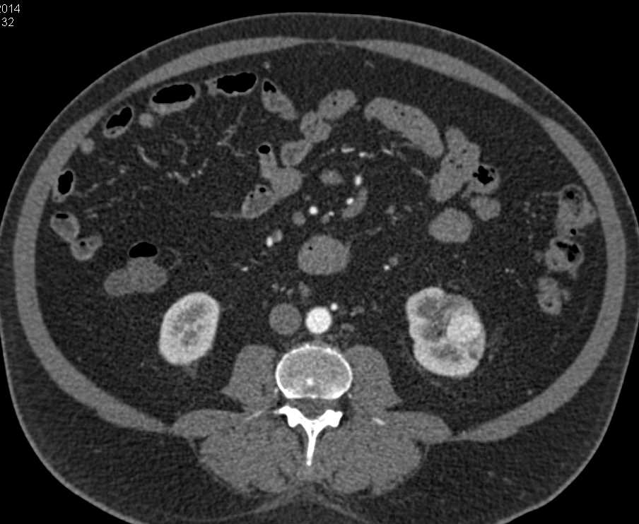 Hypervascular Left Renal Cell Carcinoma was a Clear Cell RCC - CTisus CT Scan