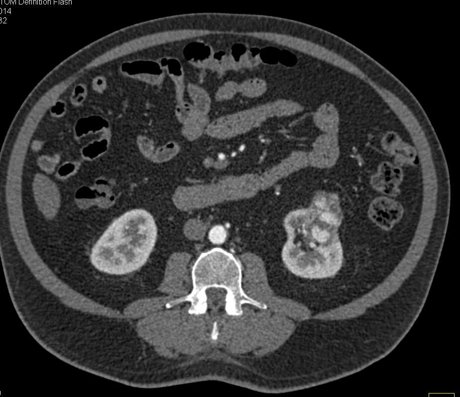 Clear Cell Left Renal Cell Carcinoma - CTisus CT Scan