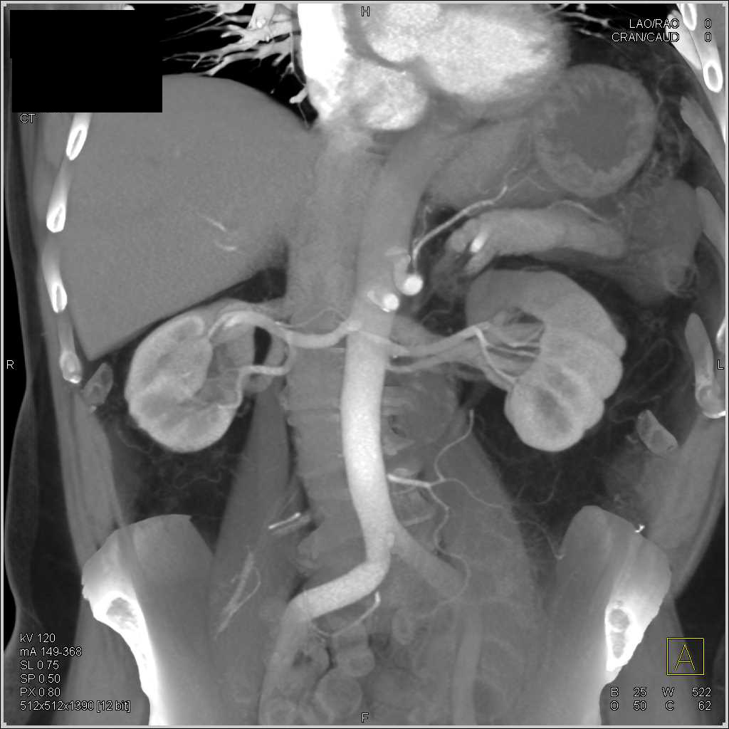 Papillary Renal Cell Carcinoma Right Kidney - CTisus CT Scan