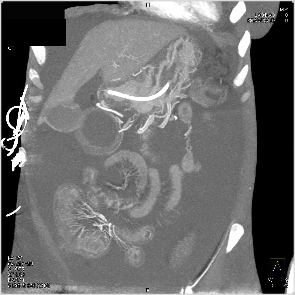 Incidental Renal Cell Carcinoma and Ischemic Bowel - CTisus CT Scan