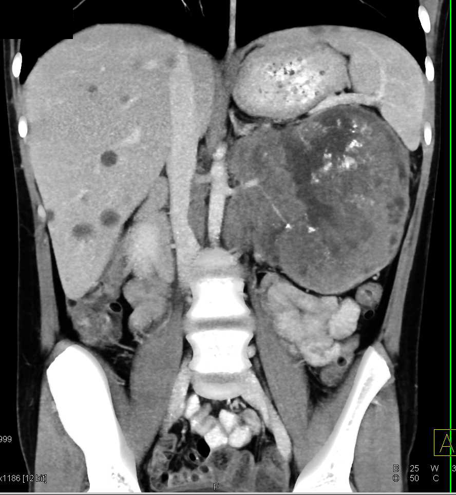 Dystrophic Renal Cell Carcinoma with Vascular Involvement - CTisus CT Scan