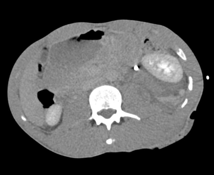 Left Renal Laceration with an Active Bleed - CTisus CT Scan