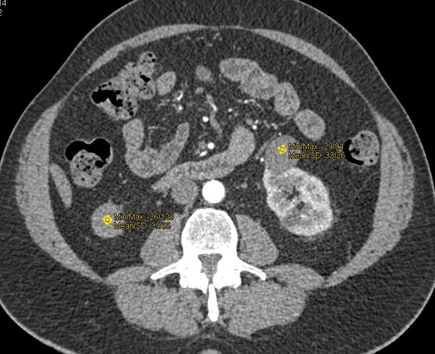 High Density Renal Cysts - CTisus CT Scan