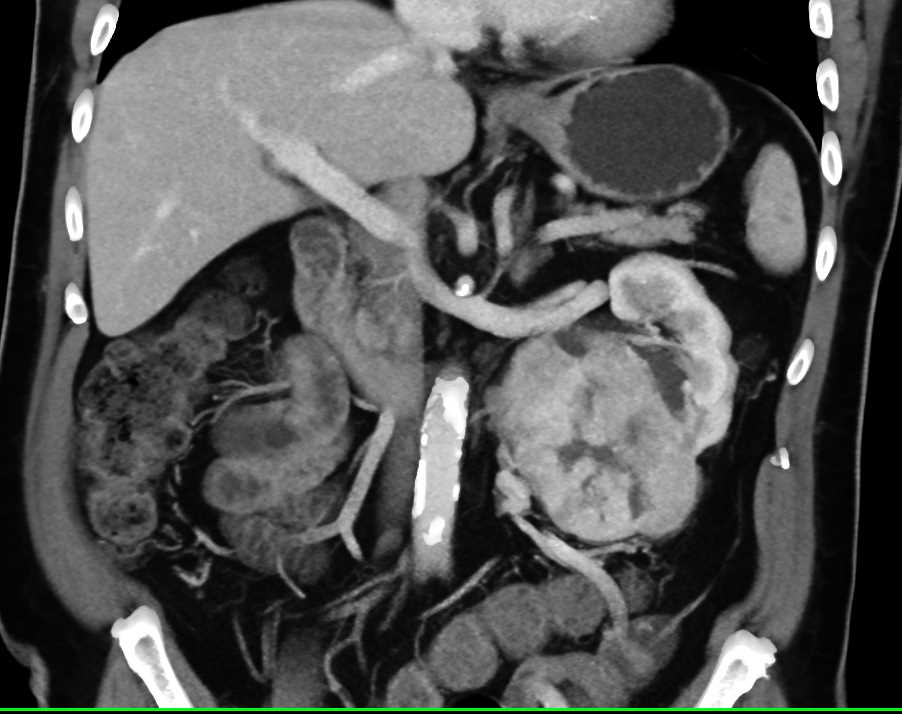 Clear Cell Renal Cell Carcinoma - CTisus CT Scan