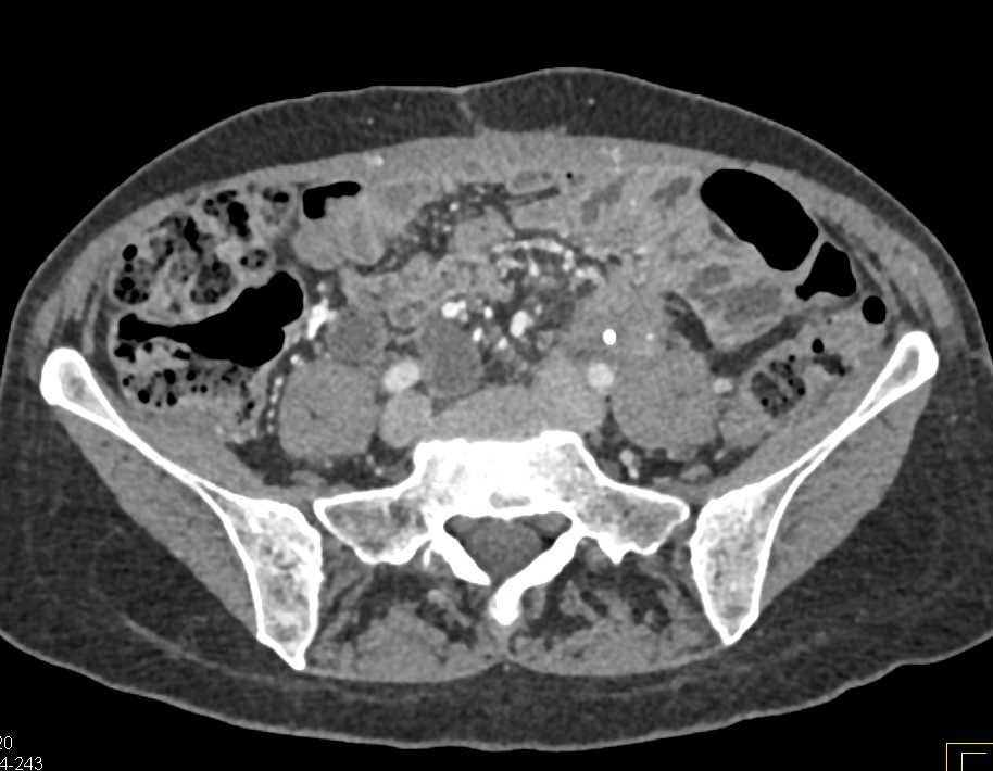 Transitional Cell Carcinoma of the Left Ureter - CTisus CT Scan