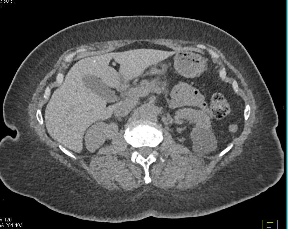 Papillary Renal Cell Carcinoma Upper Pole Right Kidney - CTisus CT Scan