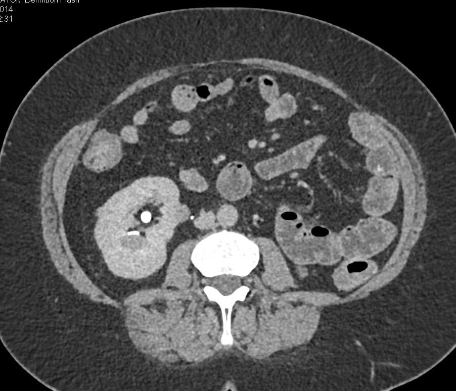 Metastatic Renal Cell Carcinoma to Contralateral Kidney, Liver and Pancreas - CTisus CT Scan