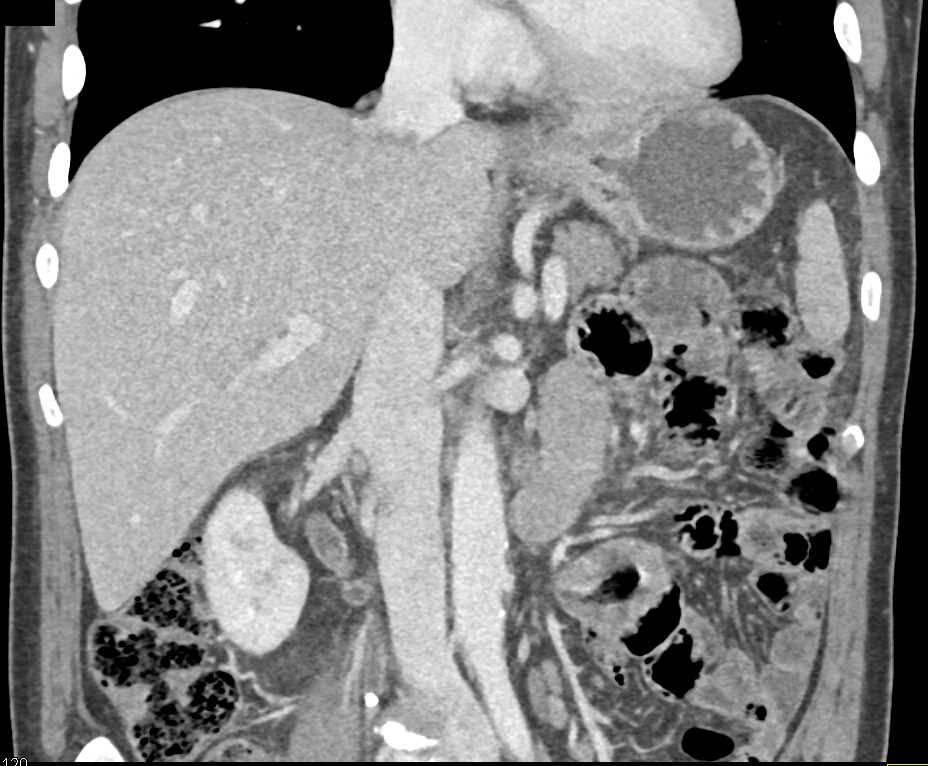 Transitional Cell Cancer (TCC) Right Renal Pelvis and Proximal Ureter - CTisus CT Scan