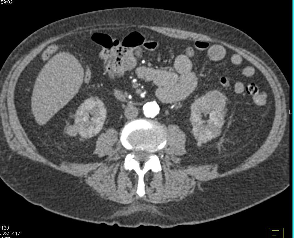 Papillary Renal Cell Carcinoma Left Kidney - CTisus CT Scan