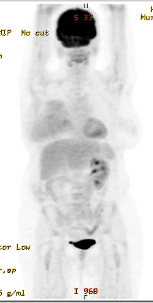 Metastatic Renal Cell Carcinoma to the Brain - CTisus CT Scan