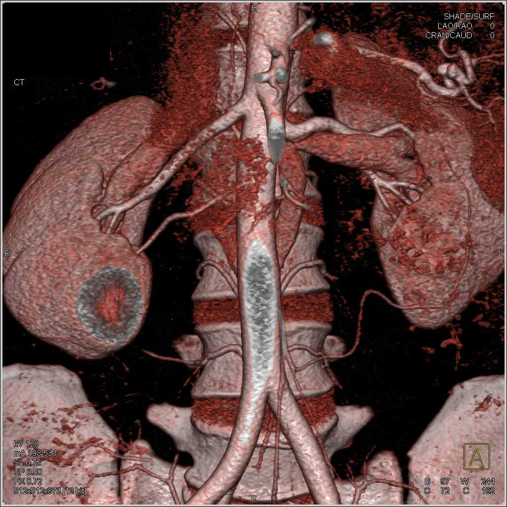 Two Right Renal Arteries Kidney Case Studies Ctisus Ct Scanning