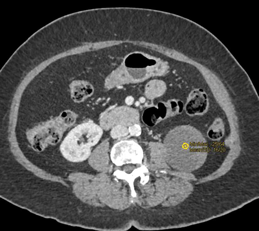 Cystic Left Renal Cell Carcinoma - CTisus CT Scan