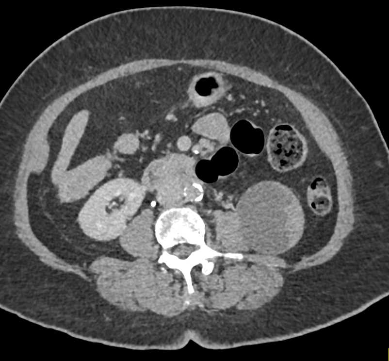 Papillary Left Renal Cell Carcinoma - CTisus CT Scan