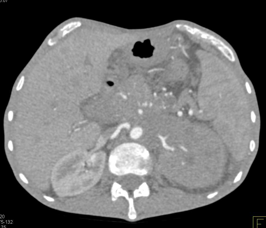 Lymphoma Infiltrating the Left Kidney - CTisus CT Scan