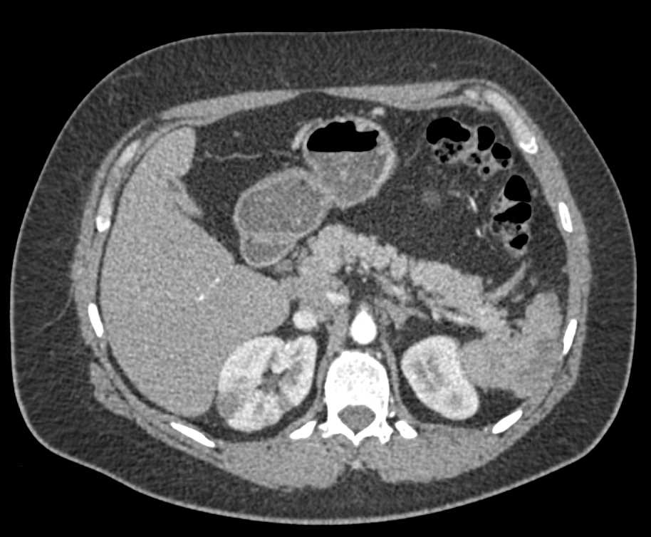Renal and Splenic Infarcts - CTisus CT Scan