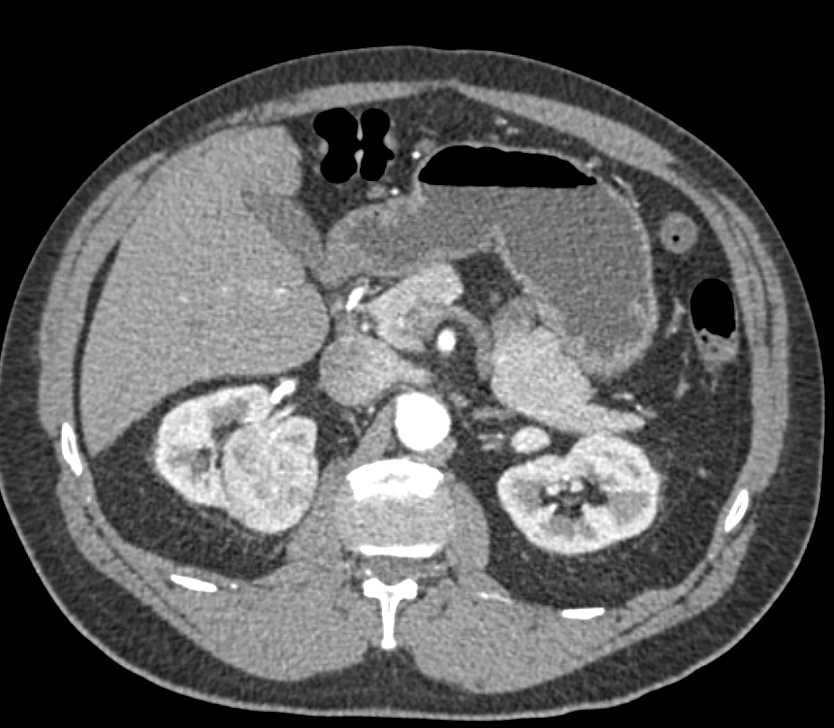 Clear Cell Renal Cell Carcinoma - CTisus CT Scan