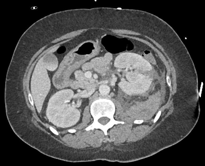 Left Perirenal Bleed Following a Renal Biopsy - CTisus CT Scan