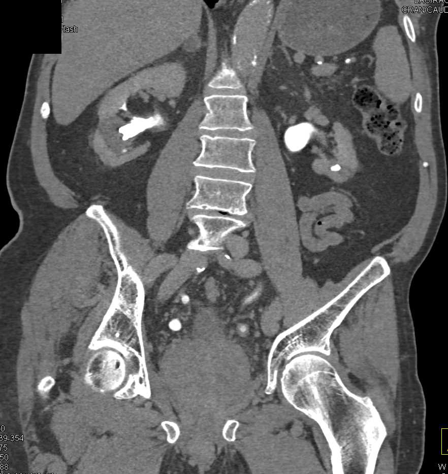 Scaring Right Kidney without Neoplasm - CTisus CT Scan