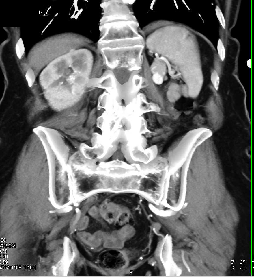 Left Nephrectomy for Renal Cell Carcinoma (RCC) with Metastases to the Pancreas, Adrenal, and Nodes - CTisus CT Scan