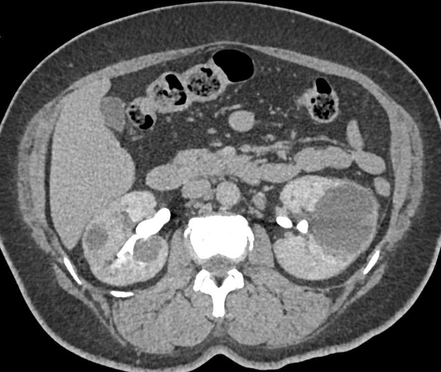 Acute Pyelonephritis Bilaterally - CTisus CT Scan