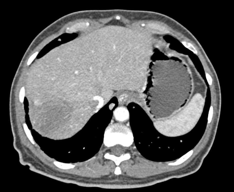 Metastatic Renal Cell cCarcinoma to the Lungs, Liver and Adenopathy - CTisus CT Scan