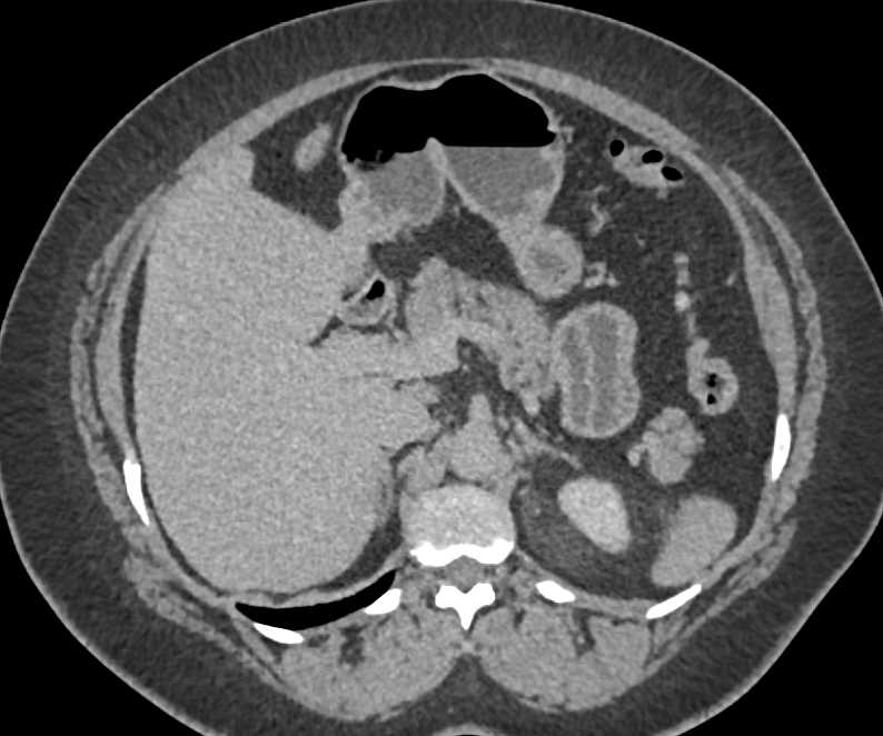 Left Renal Angiomyolipoma - CTisus CT Scan