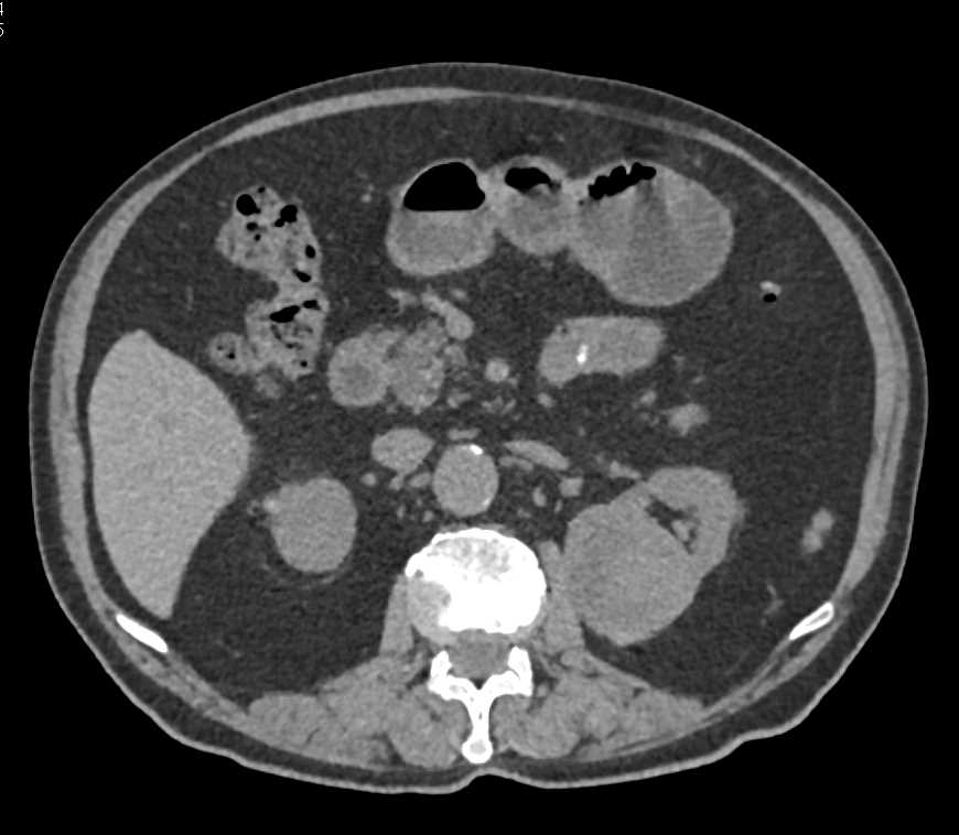 Clear Cell Left Renal Cell Carcinoma - CTisus CT Scan