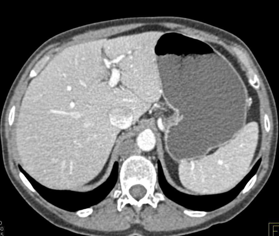 Cystic Renal Cell Carcinoma with Para-Aortic Adenopathy - CTisus CT Scan