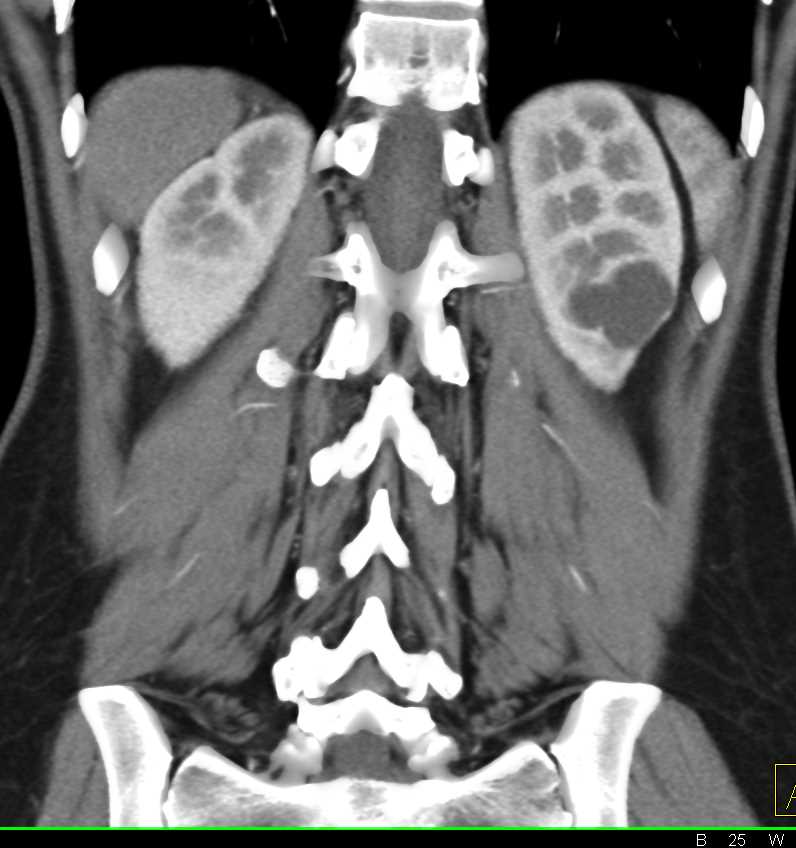Dilated Calyces in the Lower Pole of the Left Kidney - CTisus CT Scan