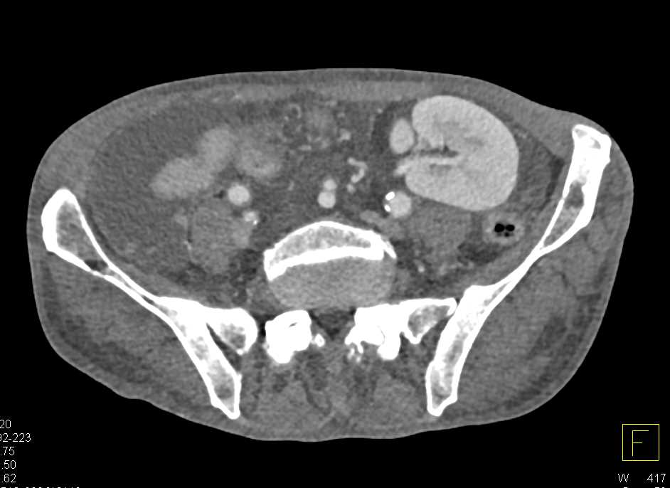 Transplant Kidneys with Ascites - CTisus CT Scan