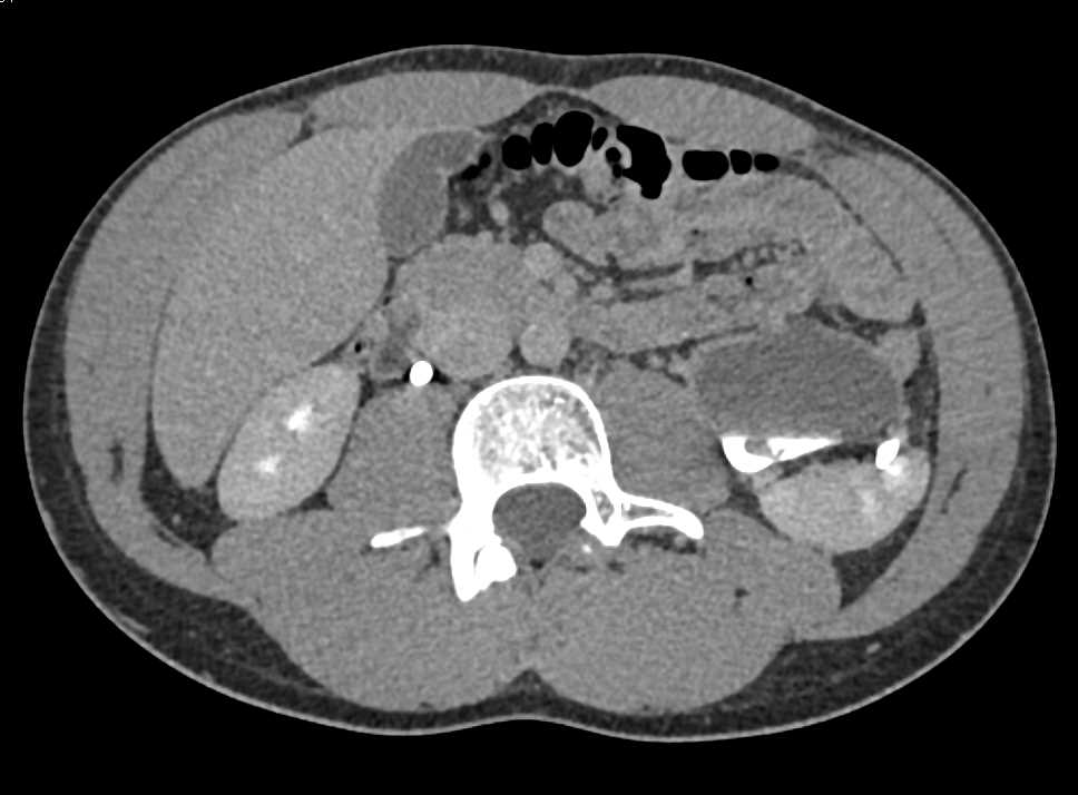 Left Ureteropelvic Junction (UPJ) with Clot in the Renal Pelvis - CTisus CT Scan