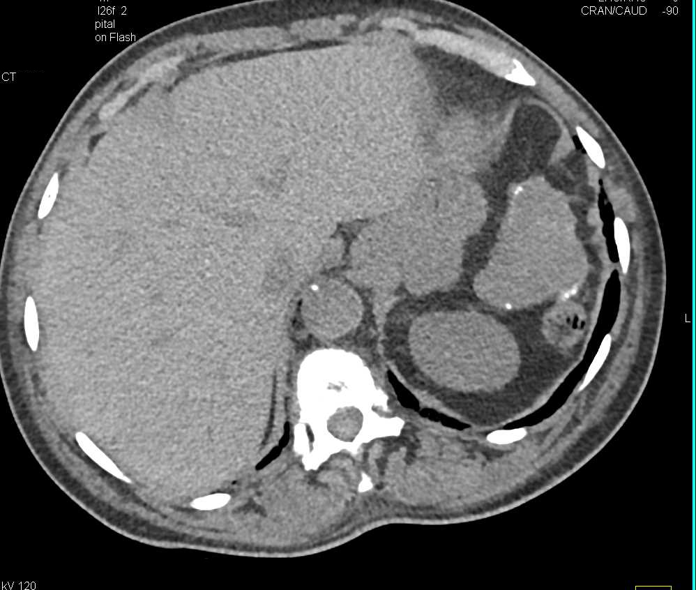 Papillary Necrosis of the Collecting Systems - CTisus CT Scan