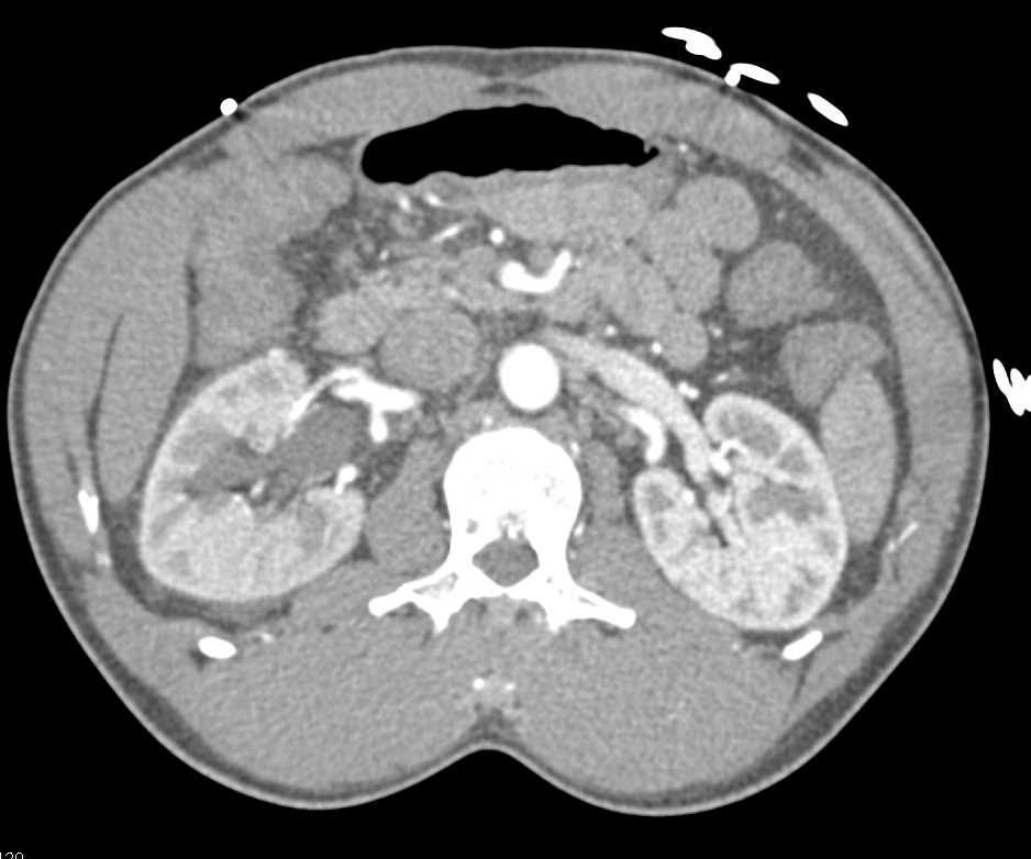 Obstructed Right Ureter and Kidney by a Stone in the Distal Right Ureter - CTisus CT Scan